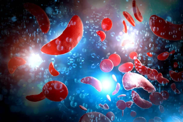 Sichelzellanämie Scd Blutkörperchen Illustration — Stockfoto