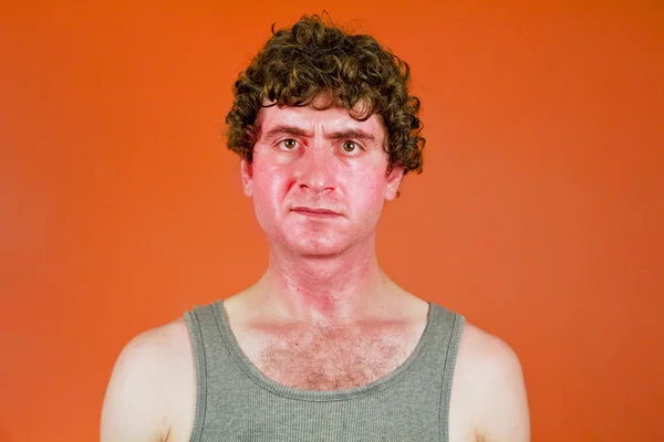 Sunburned Sweaty Man — Stock Photo, Image