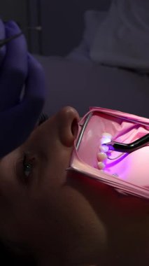 Diş hekiminin, ultraviyole ışıkla doldurduğu bileşik dokuya yakın çekim. Polimerleşme süreci, çürük tedavisi, diş bakımı, modern dişçilik, ağız bakımı.