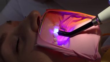 Diş hekiminin, ultraviyole ışıkla doldurduğu bileşik dokuya yakın çekim. Polimerleşme süreci, çürük tedavisi, diş bakımı, modern dişçilik, ağız bakımı.