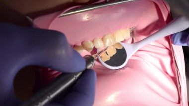 Diş hekiminin bileşik dolguyu şekillendirdiği ve diş yüzeyinde doğal çatlaklar oluşturduğu yakın plan. Hassas dişçilik, restorasyon anatomisi, estetik dişçilik, çürük tedavisi.