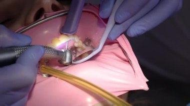 Diş çürüğünü ön dişlerde diş matkabıyla temizlerken yakın plan. Lastik baraj izolasyonu, profesyonel çürük tedavisi, modern dişçilik prosedürü ve oral bakım..