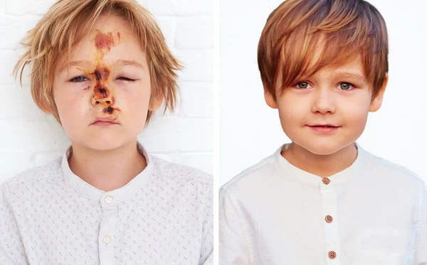 A comparison of the same boy, healthy and with the injury caused by a fall from a bicycle — Stock Photo, Image