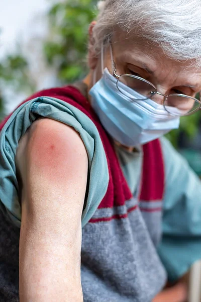 Vaccineudslæt Ældre Kvindes Arm - Stock-foto