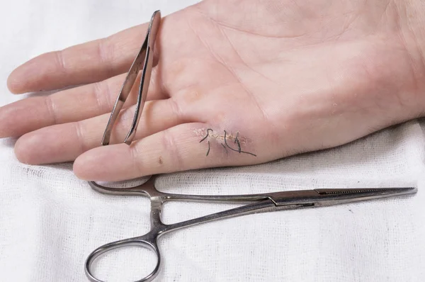 Ferida com pontos na mão do homem com equipamento médico — Fotografia de Stock