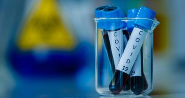 COVID 'li yakın çekim tüpleri. Hastanenin araştırma laboratuvarında cam bardaklara yerleştirilmiş 19 kan örneği.