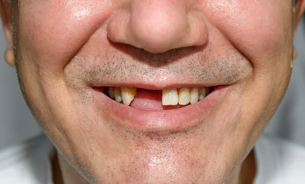 kıllar ile diş olmadan gülümse