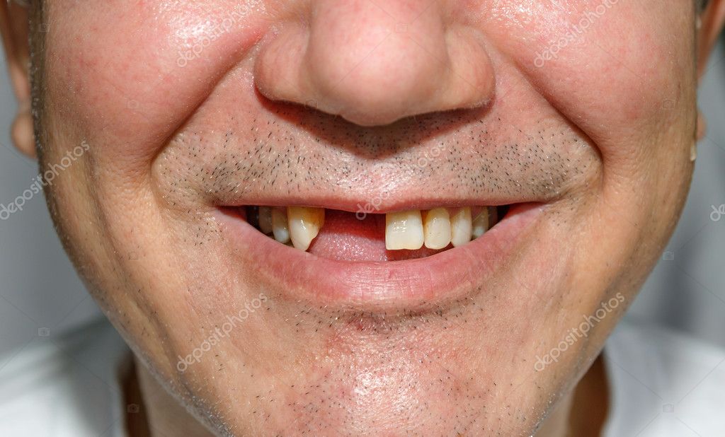 bristles teeth