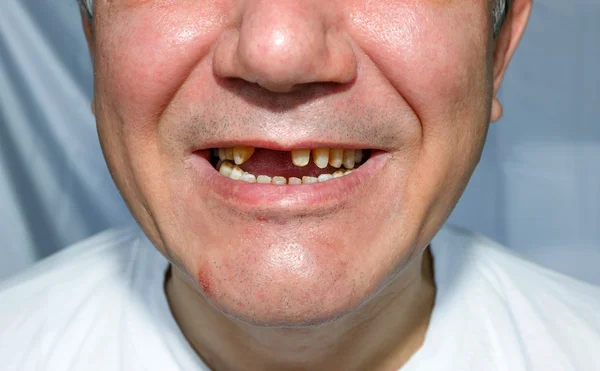 Homens sorriem descascados dentes superiores — Fotografia de Stock