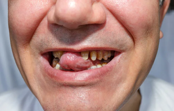 舌で皮をむいた歯を持つ男性 — ストック写真