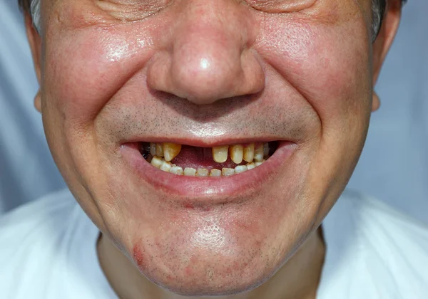 Ošklivý muž s loupanými zuby poškrábaný obličej — Stock fotografie