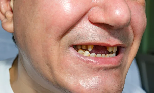 Człowiek bez i obrane zębami — Zdjęcie stockowe