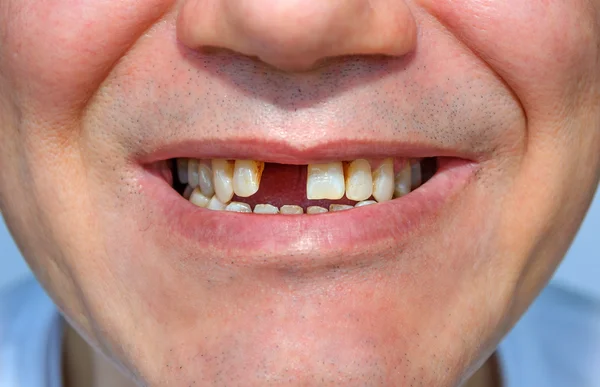 Smile without tooth1 — Stock Photo, Image