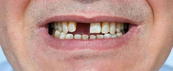 Uśmiech bez zębów — Zdjęcie stockowe