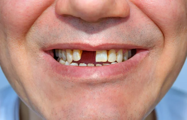 Uśmiech bez tooth1 — Zdjęcie stockowe