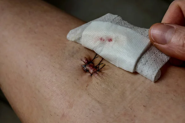 Fresh wound with stitches, background