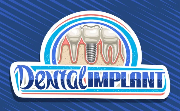 Векторный Логотип Клиники Зубной Имплантат Художественный Дизайн Декоративной Вывески Иллюстрацией — стоковый вектор