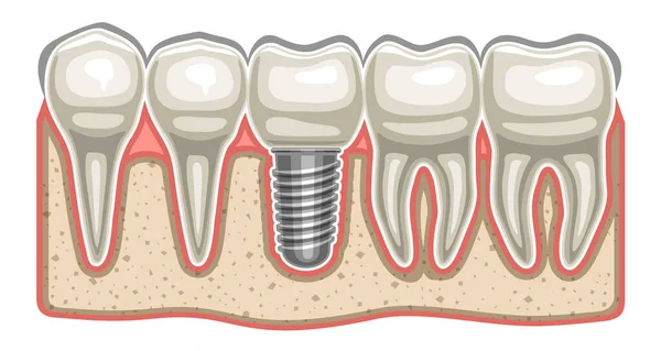 Векторная Иллюстрация Зубного Импланта Человеческих Зубов Подряд Керамический Искусственный Зуб — стоковый вектор