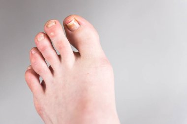 Gri arka planda ayak tırnağı zarar görmüş. Yaya olarak nasır.