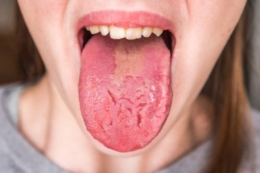 Dilinde çatlaklar var. Candiasis. Candida. Doğuştan patoloji..