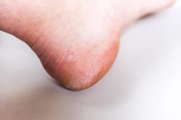 Сухая Женщина Большой Палец Ноги Грубой Кожей Сером Фоне — стоковое фото