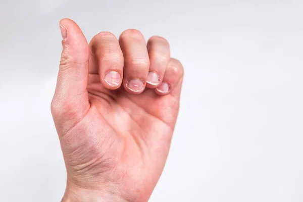 Δάχτυλα Άσχημα Μασημένα Νύχια Γκρι Φόντο — Φωτογραφία Αρχείου