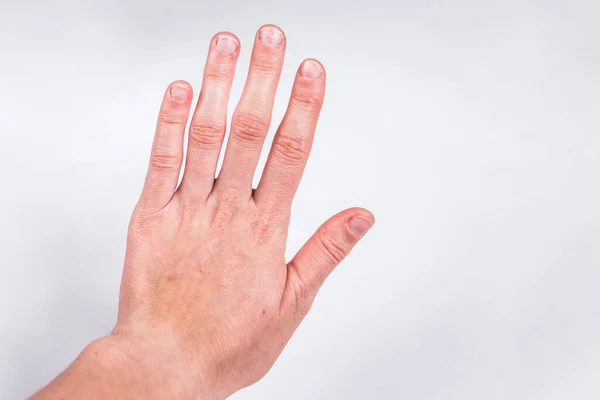 Fingers Badly Chewed Bitten Nails Gray Background — Stock Photo, Image