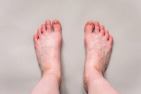 Damaged toenail on big toe on gray background. Callus on foot.