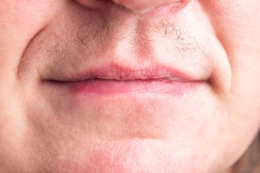 Gerçek kadın bıyığı. Kadın yüzünde erkek hormonu izleri var..