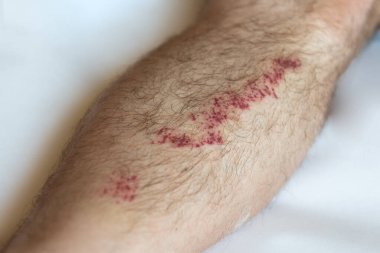 Gri arka planda bacağında yara izi var..