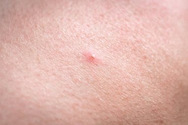 Sivilceli bir kadın derisi. Sorunlu cilt.