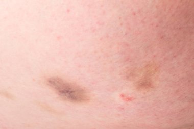 Hematom ya da beyaz deride çürükler..