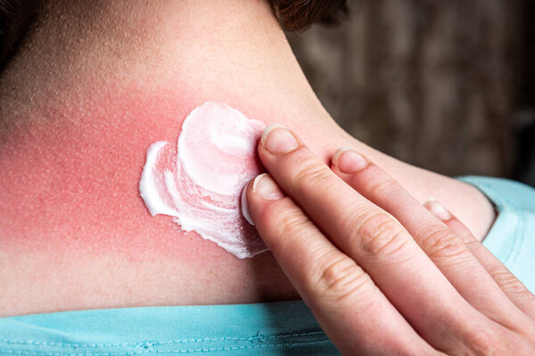 На спине женщины мажет крем после солнечного ожога.