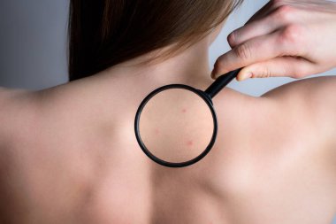 Sivilceli, kırmızı lekeli, sivilceli bir kadın. Gri arka planda büyüteci olan genç bir kız. Deri hastalıkları. 