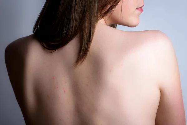 Female back with acne, red spots, pimples. Young girl with a magnifying glass on gray background. Skin diseases.