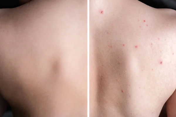 Treatment Acne Pimples Skin Back Teenager — Stock Photo, Image