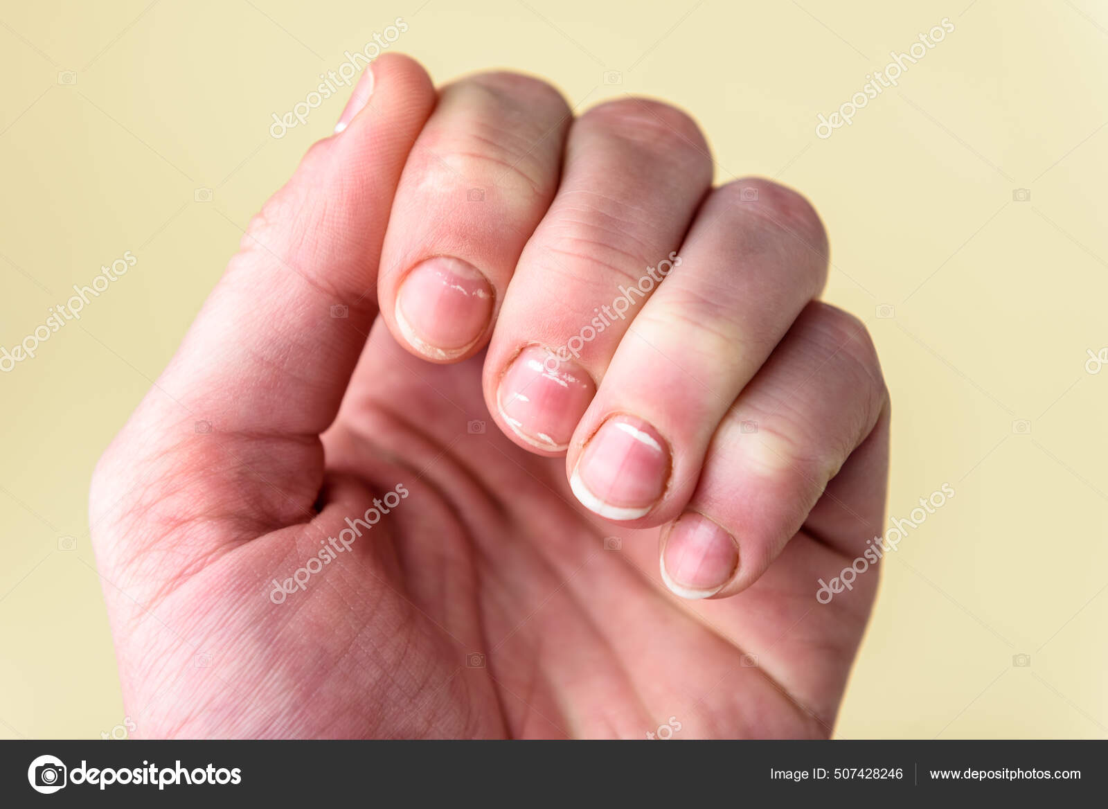 Nails White Spots Yellow Background Leukonychia Calcium Deficit Stock