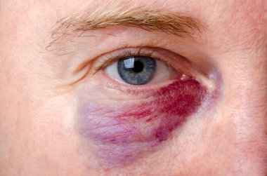 Close up on a shiner on a white man