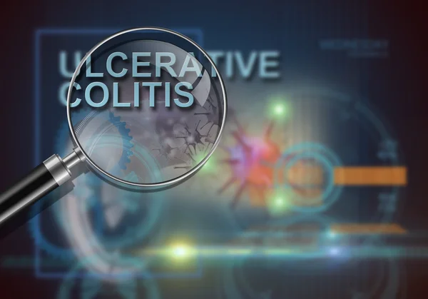 Hi tech infographics of ulcerative colitis made in 3d software — Stock Photo, Image