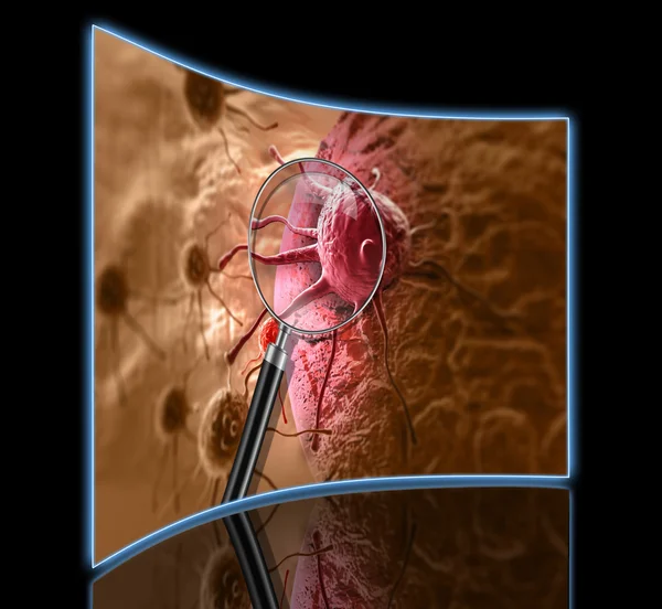 Rendering 3d di cellule tumorali nel corpo umano — Foto Stock