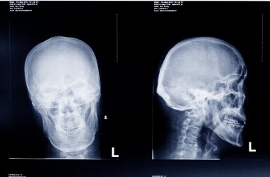 tıbbi röntgen filmi