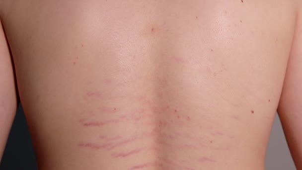 Közelkép Fiatal Gyöngyház Hátáról Striae Distensae Striae Rubrae Háttérrel Bőr — Stock videók