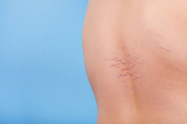 Close up view of the back with striae distensae (striae rubrae) on the skin on a blue background. The concept of impaired skin elasticity during puberty