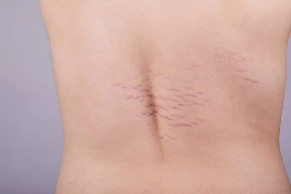 Close up view of the back with striae distensae (striae rubrae) on the skin. The concept of impaired skin elasticity during puberty