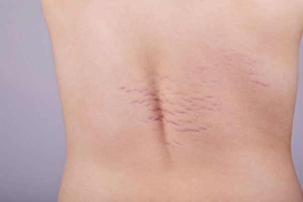 Close up view of the back with striae distensae (striae rubrae) on the skin. The concept of impaired skin elasticity during puberty