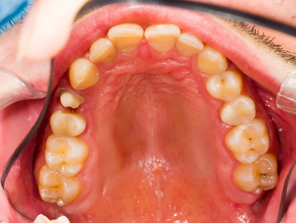 Зуб перед получением зубной коронки — стоковое фото