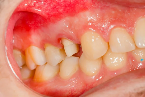 Tand innan det blir dental krona — Stockfoto