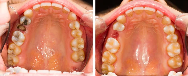 До и после стоматологического лечения — стоковое фото