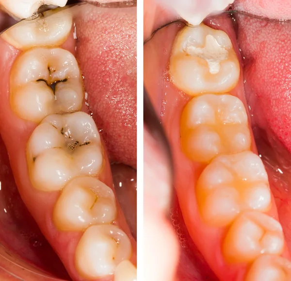 До и после стоматологического лечения Стоковое Изображение