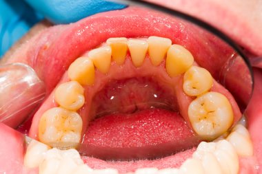 Plak çıkarıldıktan sonra insan takma diş